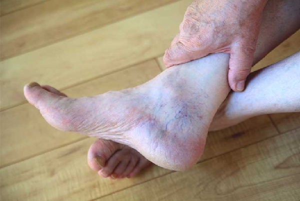 Psoriatic Arthritis