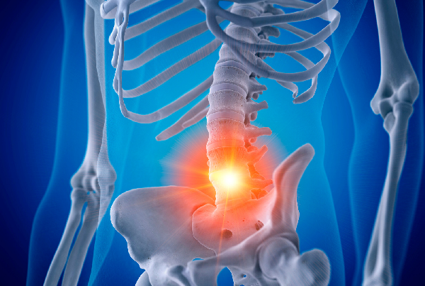 Ankylosing Spondylitis