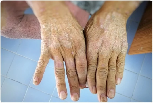 Scleroderma