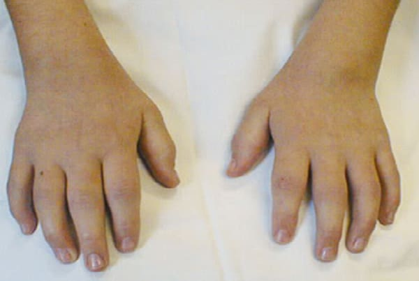 Juvenile Inflammatory Arthritis