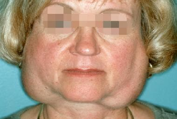 Sjogrens Syndrome