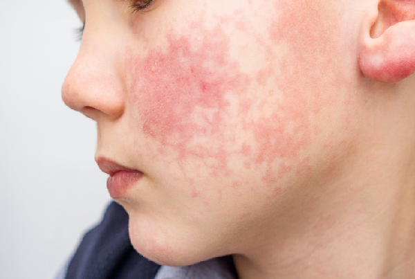 Autoimmune Myositis