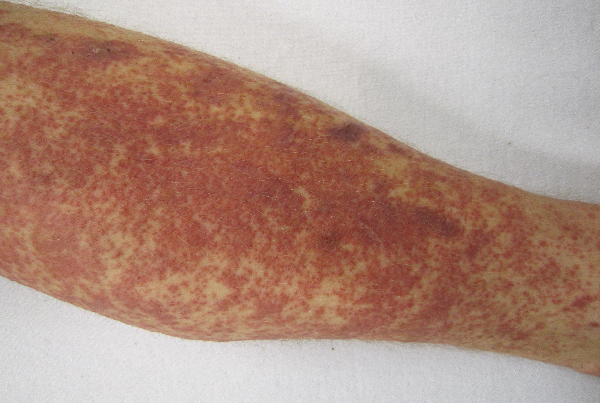 Inflammatory Arthropathies