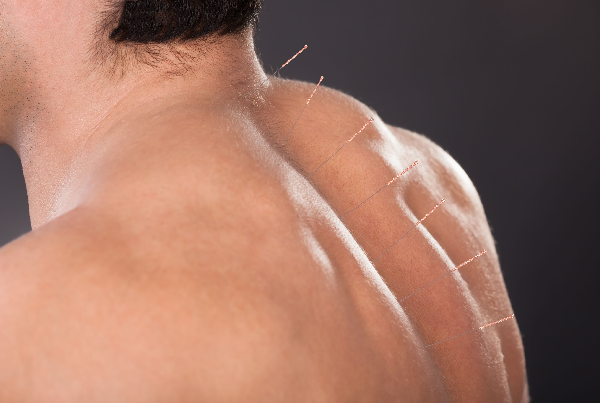 Myofascial Pain Syndromes