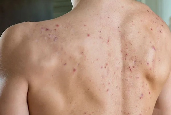 Sapho Syndrome