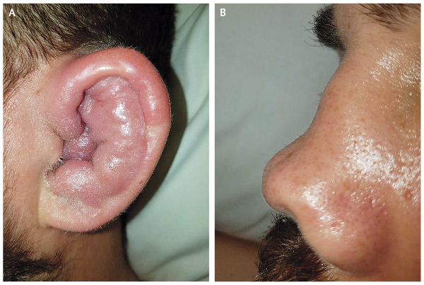 Relapsing Polychondritis