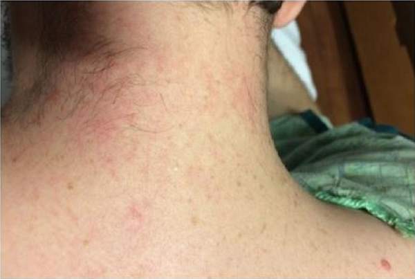 Adult Onset Stillâ€™s Disease