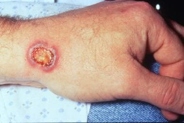 Granulomatous Polyangitis
