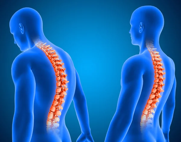 Ankylosing Spondylitis