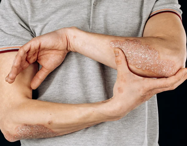 Psoriatic Arthritis