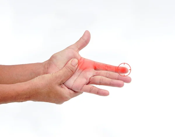 Systemic Sclerosis