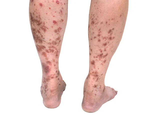 Vasculitis
