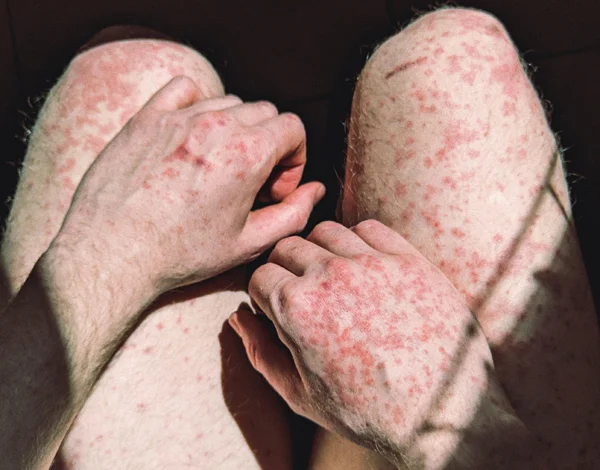 Systemic Lupus Erythematosus